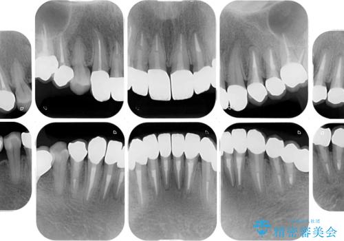 この際全てをしっかりと治療したい 総合歯科治療の治療後