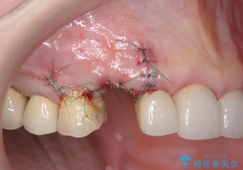 クラウン下に再発した深い虫歯 インプラントによる機能回復の治療中