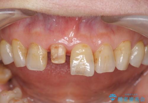 天然歯を模した ハイグレードオールセラミッククラウンの治療中