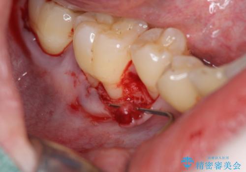 歯ぐきが下がり歯がしみる　歯肉移植による治療