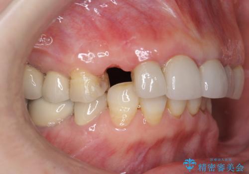 クラウン下に再発した深い虫歯 インプラントによる機能回復の治療前