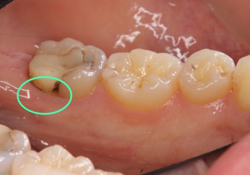 他院で次に虫歯になったら治せないと言われた 歯周外科手術でしっかり治療(APF)の治療前