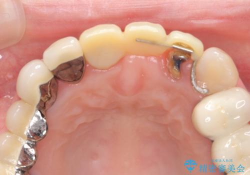 前歯ブリッジのやりかえの治療中