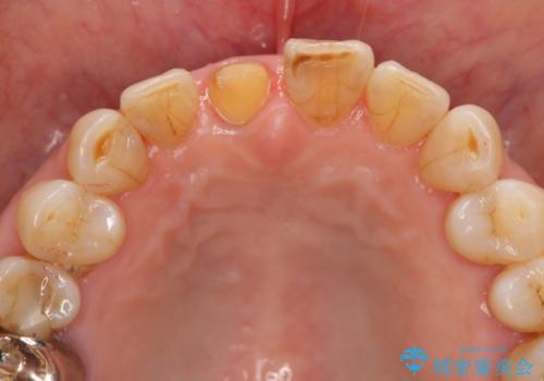 天然歯を模した ハイグレードオールセラミッククラウンの治療中
