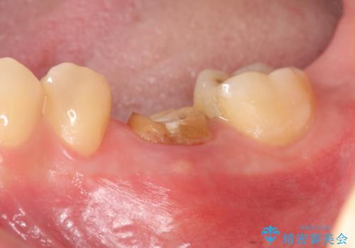 放置してしまった歯　根管治療からの機能回復の治療前
