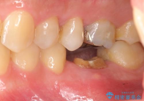 放置してしまった歯 根管治療からの機能回復の治療前