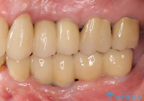虫歯による歯の喪失　インプラントによる咬合機能回復の症例 治療後