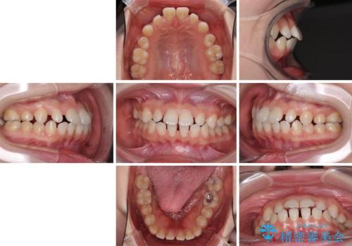 矯正治療とインプラント治療を同時に 総合歯科診療の治療前