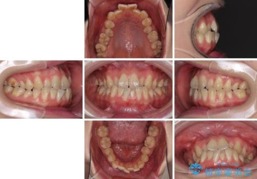 ハーフリンガル 反対咬合の改善の治療前