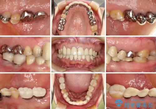 この際全てをしっかりと治療したい 総合歯科治療の治療前