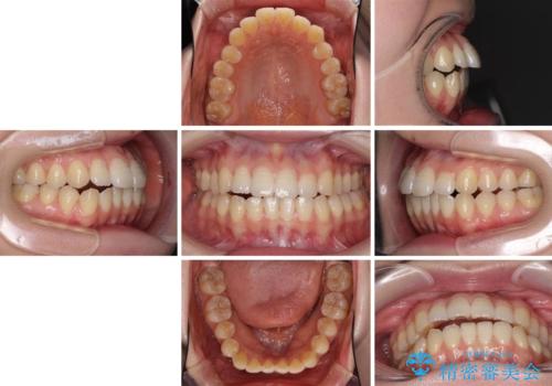 オープンバイトのインビザラインを用いた再矯正 の治療前
