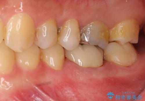 放置してしまった歯 根管治療からの機能回復の治療後