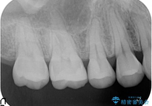 セラミックインレー メタルフリーの治療の治療後