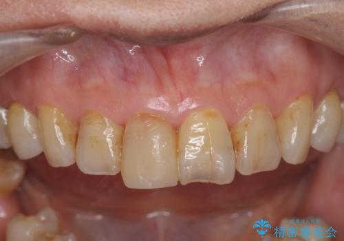 天然歯を模した ハイグレードオールセラミッククラウンの治療前