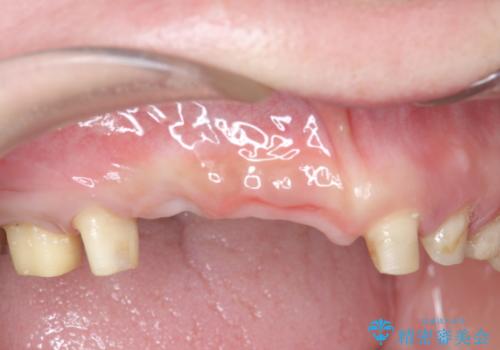 咬合性外傷による歯槽骨吸収 ブリッジ補綴の治療前