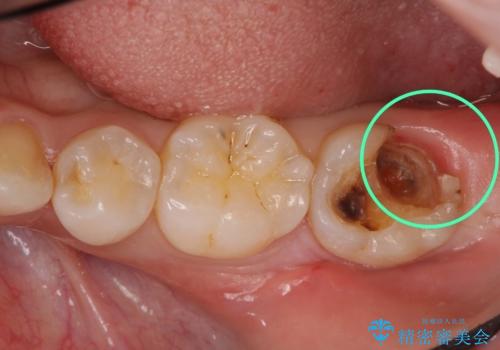 他院で次に虫歯になったら治せないと言われた　歯周外科手術でしっかり治療(APF)