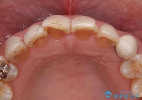 オールセラミッククラウン・セラミックインレー 口腔内全体の見た目の改善の治療前