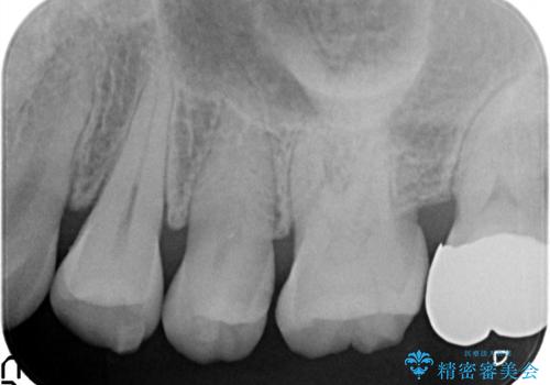 虫歯の治療。ゴールドインレーによる治療の治療前