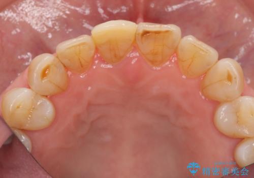 天然歯を模した ハイグレードオールセラミッククラウンの治療前