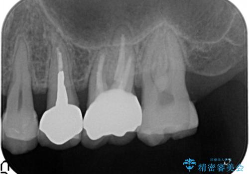 奥歯が痛い。根管治療~オールセラミッククラウンの治療の治療後