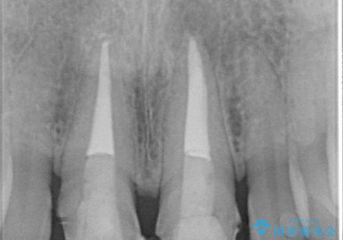 前歯をメタルフリーに　根管治療で不安を取り除いてからの治療中