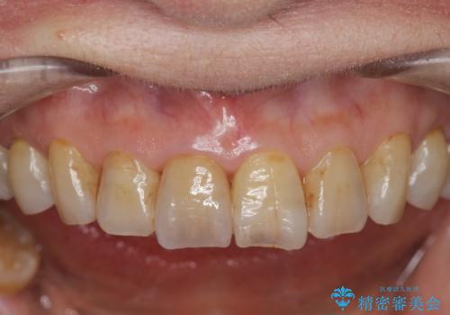 天然歯を模した ハイグレードオールセラミッククラウンの治療後