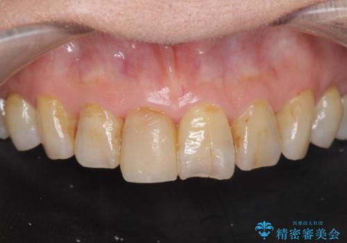 天然歯を模した ハイグレードオールセラミッククラウンの治療前