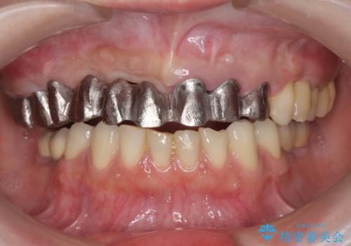 咬合性外傷による歯槽骨吸収 ブリッジ補綴の治療中