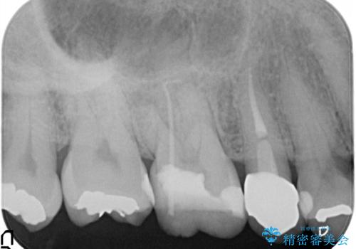 奥歯の根管治療～オールセラミッククラウンの症例 治療前