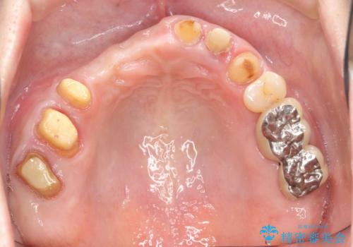 咬合性外傷による歯槽骨吸収 ブリッジ補綴の治療中
