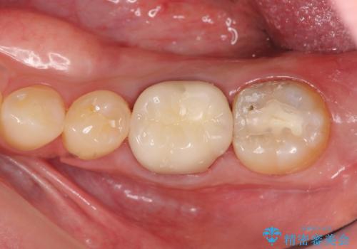 放置してしまった歯 根管治療からの機能回復の治療後