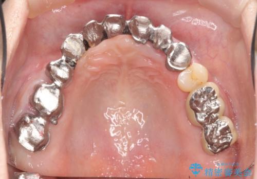 咬合性外傷による歯槽骨吸収 ブリッジ補綴の治療中