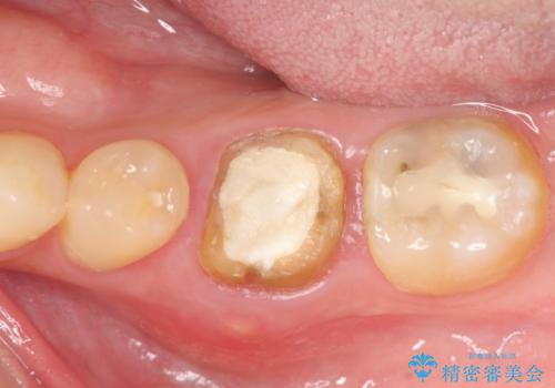 放置してしまった歯 根管治療からの機能回復の治療前