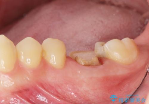 放置してしまった歯 根管治療からの機能回復の治療中