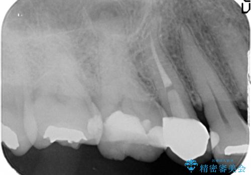 奥歯の根管治療~オールセラミッククラウンの治療前