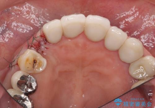 クラウン下に再発した深い虫歯 インプラントによる機能回復の治療中