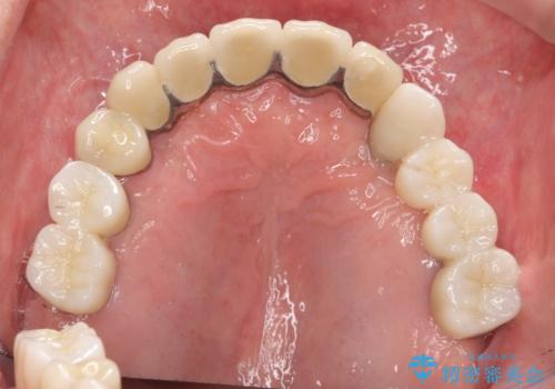 [歯周病治療]  歯周補綴　インプラント補綴の症例 治療後