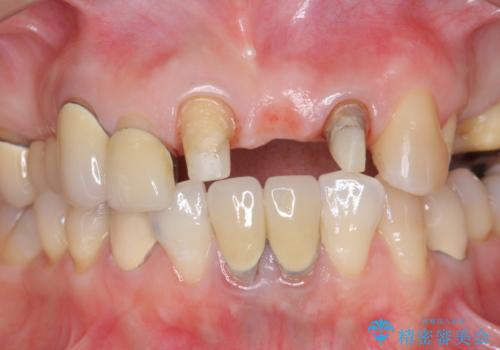 前歯ブリッジのやりかえの治療中