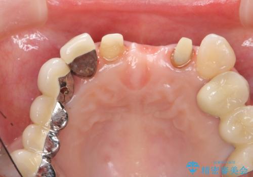 前歯ブリッジのやりかえの治療中