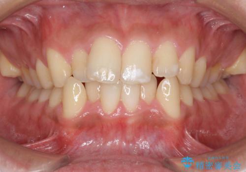 歯を抜かない矯正　奥歯のすれ違い咬合　下の八重歯　