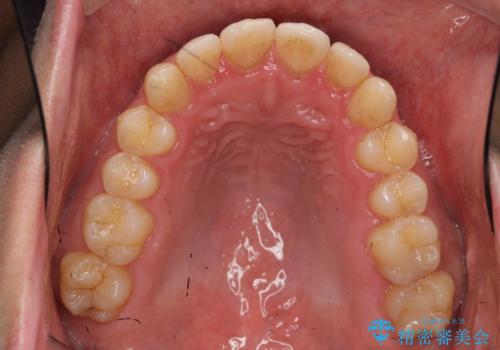 歯を抜かない矯正 奥歯のすれ違い咬合 下の八重歯 の治療後