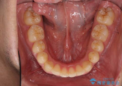 歯を抜かない矯正 奥歯のすれ違い咬合 下の八重歯 の治療後