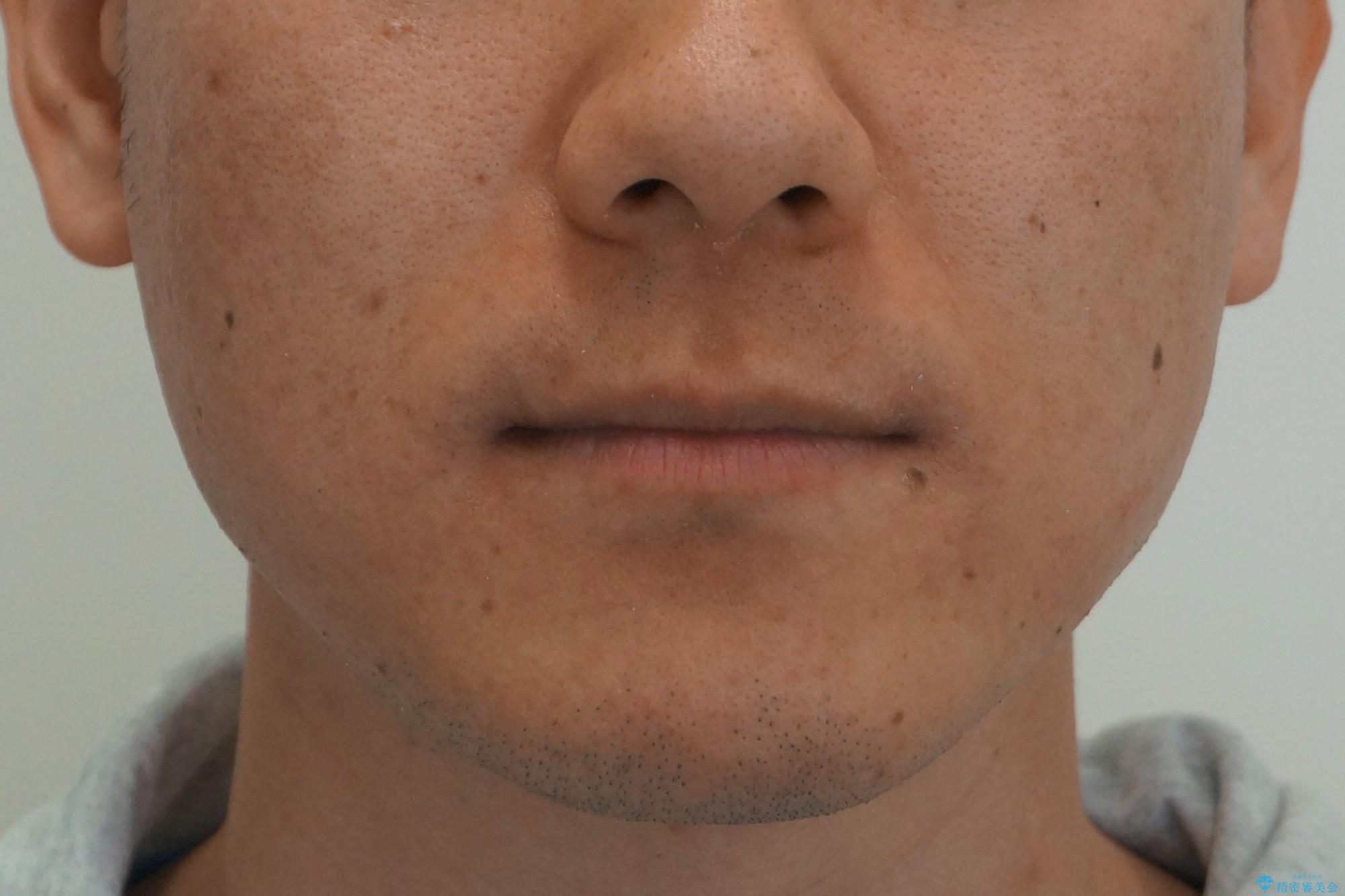 受け口 マウスピースで矯正治療 難易度:中の治療後(顔貌)