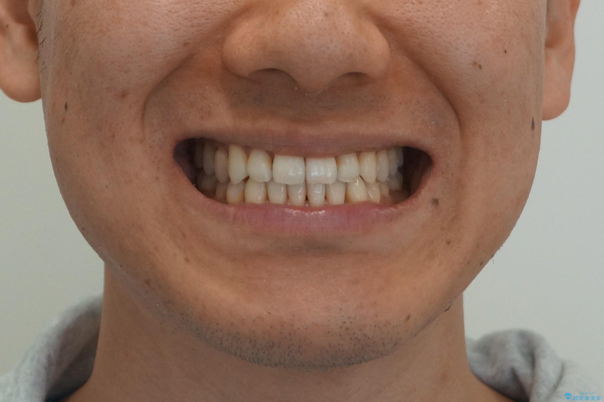 受け口 マウスピースで矯正治療 難易度:中の治療後(顔貌)