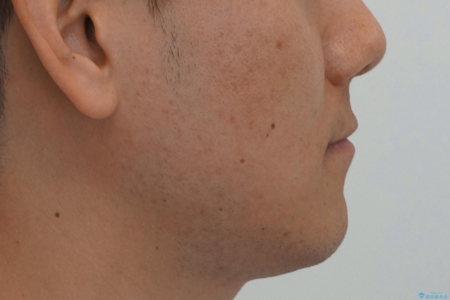 受け口 マウスピースで矯正治療 難易度:中の治療後(顔貌)