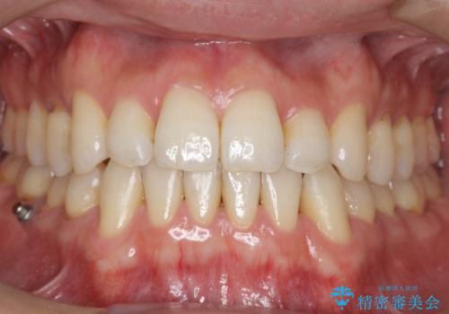 受け口 マウスピースで矯正治療 難易度:中の症例 治療後