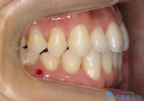 受け口 マウスピースで矯正治療 難易度:中の治療後