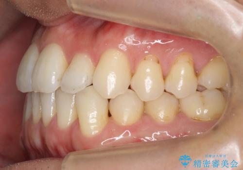 受け口 マウスピースで矯正治療 難易度:中の治療後