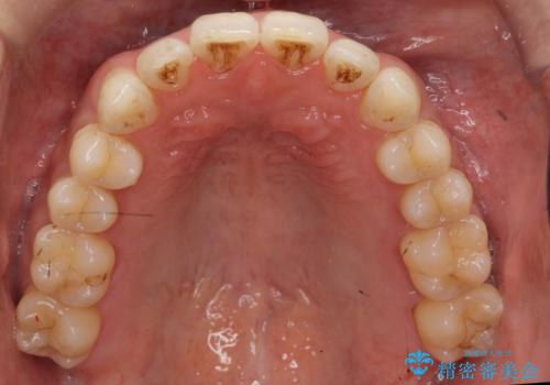 受け口 マウスピースで矯正治療 難易度:中の治療後