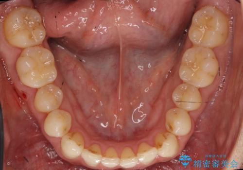 受け口 マウスピースで矯正治療 難易度:中の治療後